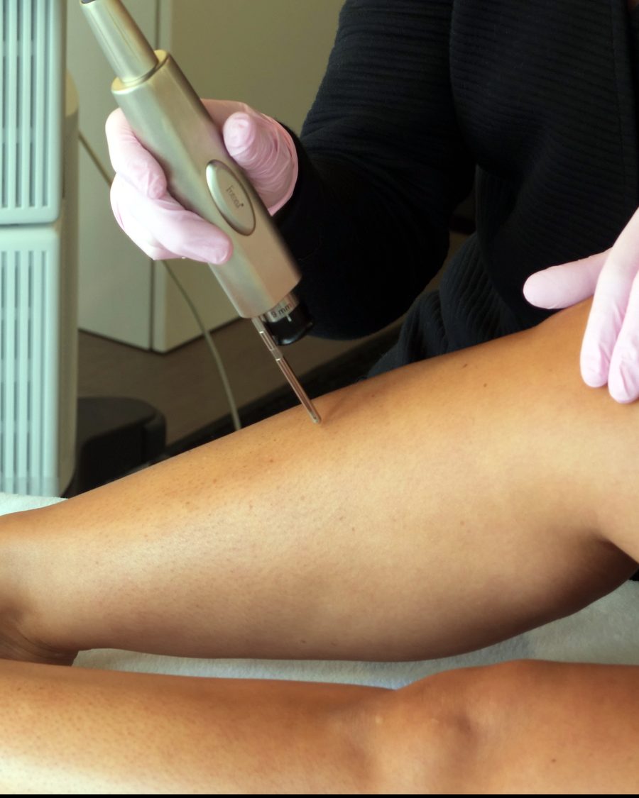 Pièce à main du laser appliquée sur la peau